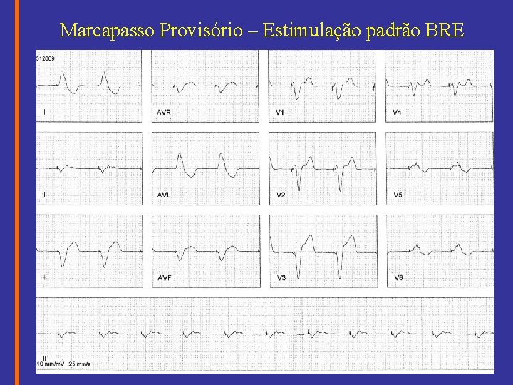 Marcapasso Provisório – Estimulação padrão BRE 