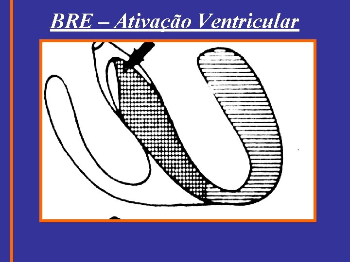 BRE – Ativação Ventricular 