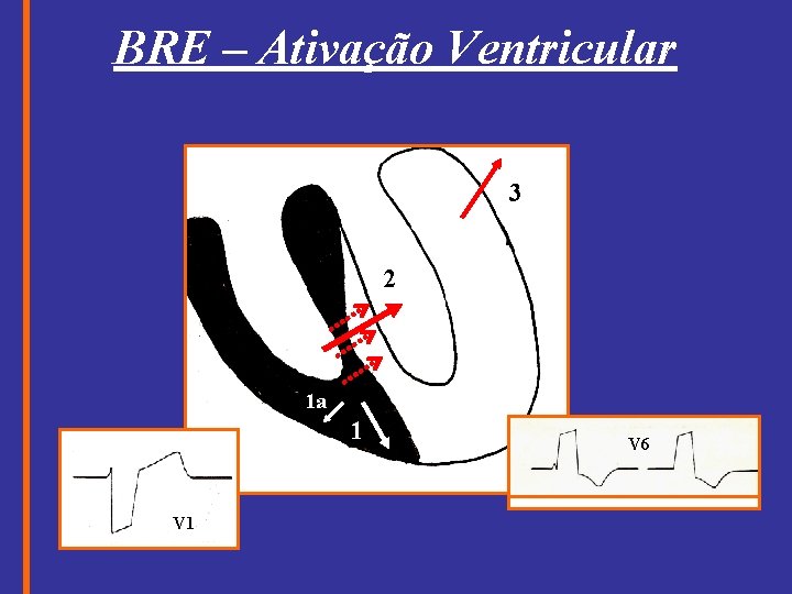 BRE – Ativação Ventricular 3 2 1 a 1 V 6 