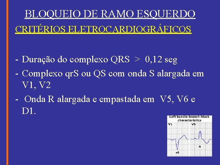 BLOQUEIO DE RAMO ESQUERDO CRITÉRIOS ELETROCARDIOGRÁFICOS - Duração do complexo QRS > 0, 12