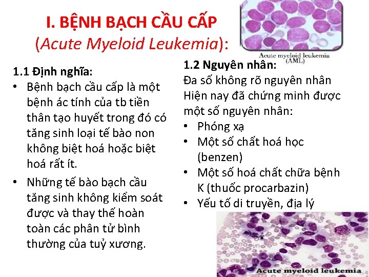 I. BỆNH BẠCH CẦU CẤP (Acute Myeloid Leukemia): 1. 1 Định nghĩa: • Bệnh
