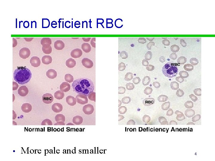 Iron Deficient RBC • More pale and smaller 4 