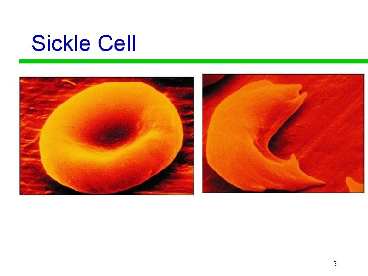 Sickle Cell 5 