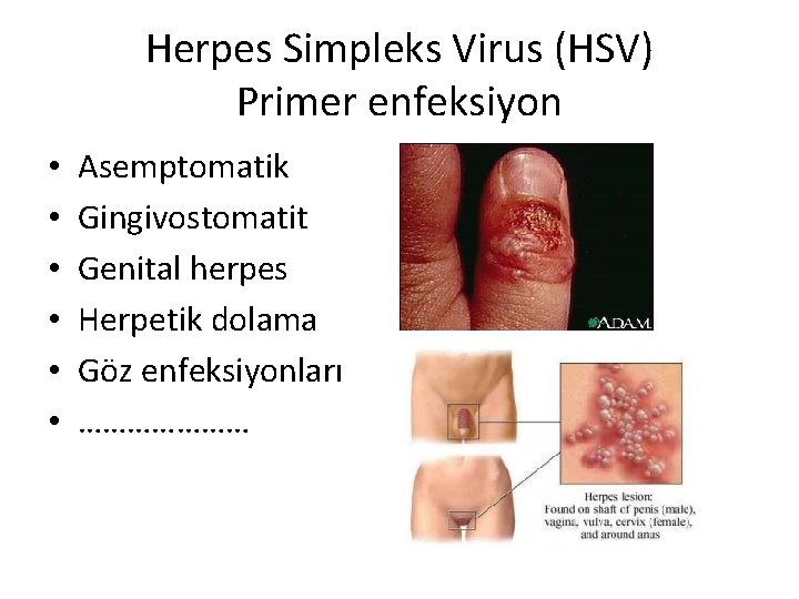 Herpes Simpleks Virus (HSV) Primer enfeksiyon • • • Asemptomatik Gingivostomatit Genital herpes Herpetik