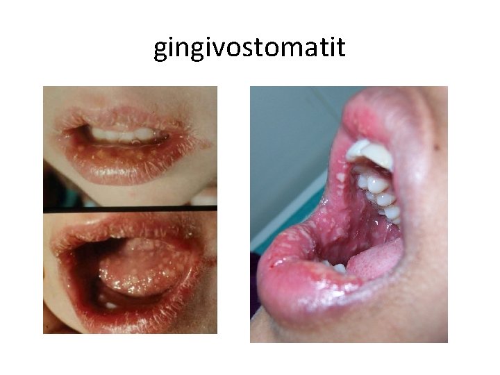 gingivostomatit 