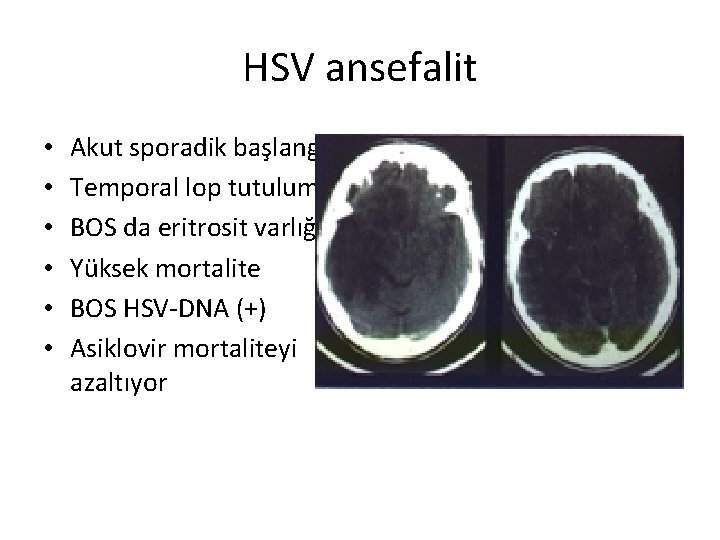 HSV ansefalit • • • Akut sporadik başlangıç Temporal lop tutulumu BOS da eritrosit