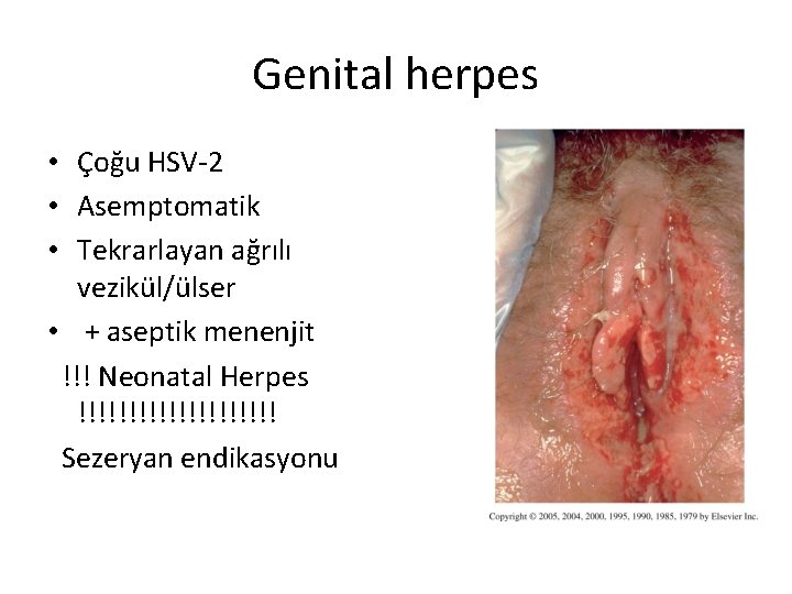 Genital herpes • Çoğu HSV-2 • Asemptomatik • Tekrarlayan ağrılı vezikül/ülser • + aseptik