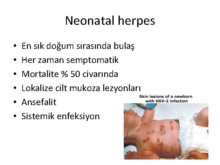 Neonatal herpes • • • En sık doğum sırasında bulaş Her zaman semptomatik Mortalite