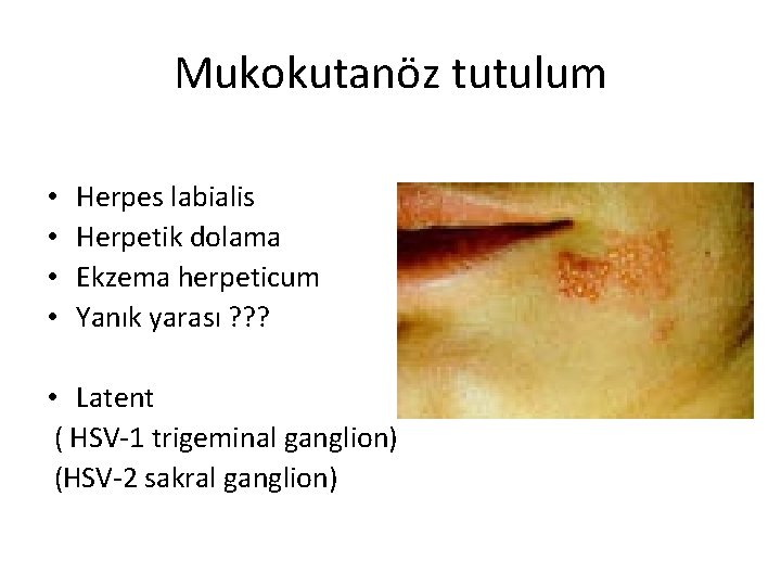 Mukokutanöz tutulum • • Herpes labialis Herpetik dolama Ekzema herpeticum Yanık yarası ? ?