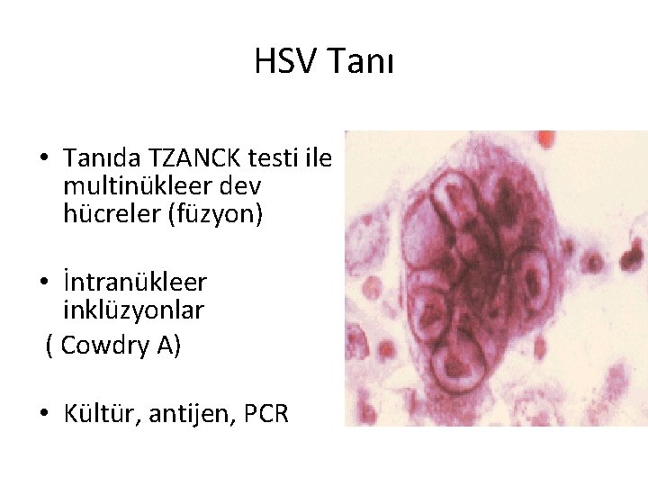 HSV Tanı • Tanıda TZANCK testi ile multinükleer dev hücreler (füzyon) • İntranükleer inklüzyonlar