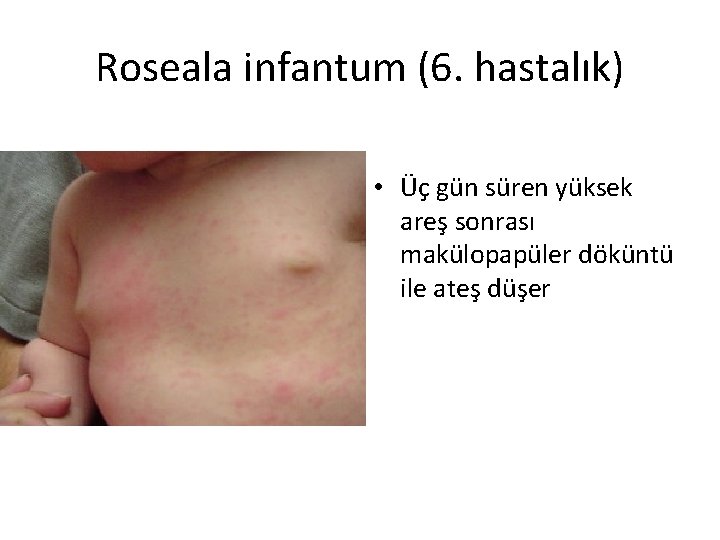Roseala infantum (6. hastalık) • Üç gün süren yüksek areş sonrası makülopapüler döküntü ile