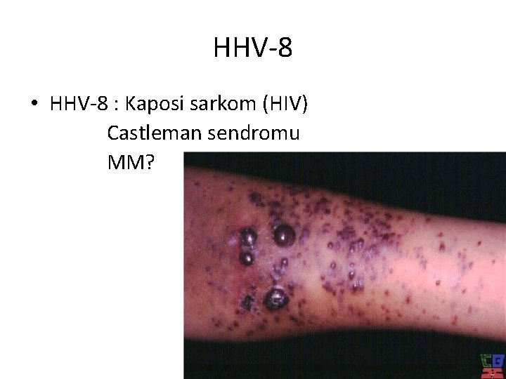 HHV-8 • HHV-8 : Kaposi sarkom (HIV) Castleman sendromu MM? 