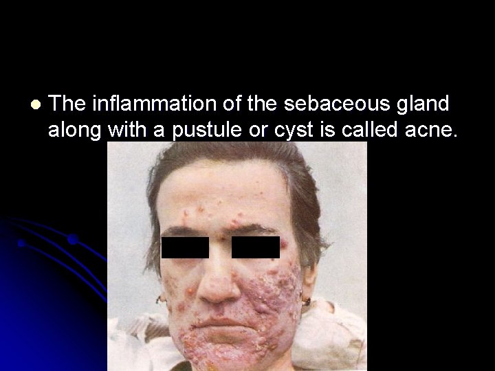 l The inflammation of the sebaceous gland along with a pustule or cyst is