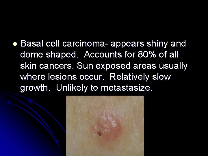 l Basal cell carcinoma- appears shiny and dome shaped. Accounts for 80% of all