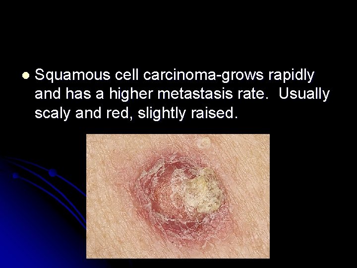 l Squamous cell carcinoma-grows rapidly and has a higher metastasis rate. Usually scaly and