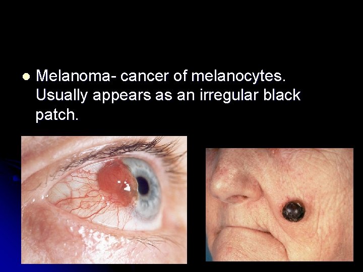 l Melanoma- cancer of melanocytes. Usually appears as an irregular black patch. 