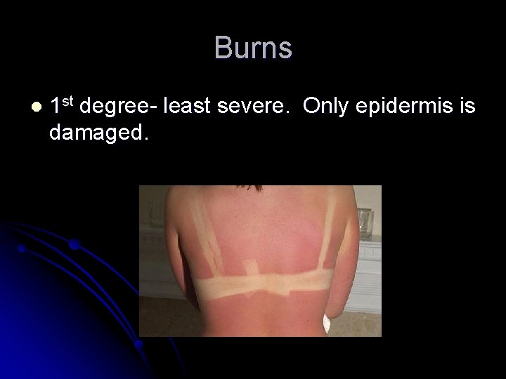 Burns l 1 st degree- least severe. Only epidermis is damaged. 
