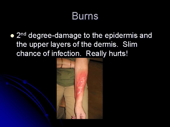 Burns l 2 nd degree-damage to the epidermis and the upper layers of the