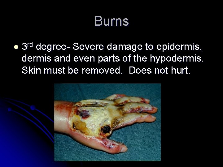 Burns l 3 rd degree- Severe damage to epidermis, dermis and even parts of