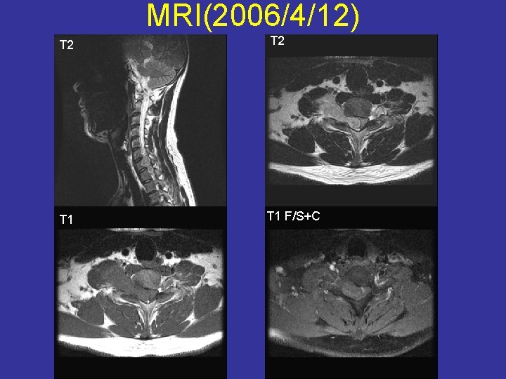 MRI(2006/4/12) T 2 T 1 F/S+C 