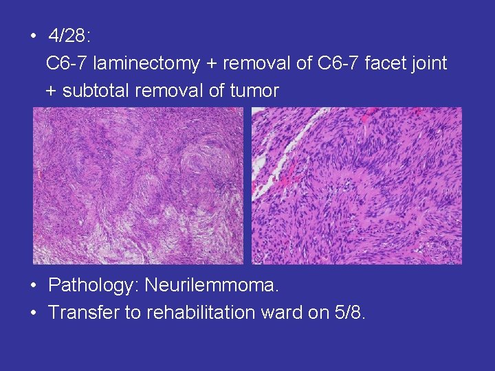  • 4/28: C 6 -7 laminectomy + removal of C 6 -7 facet