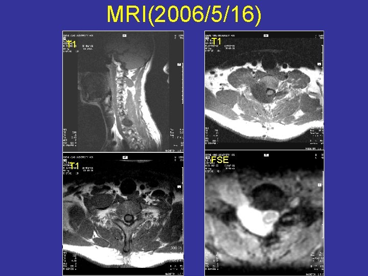 MRI(2006/5/16) T 1 T 1 FSE 