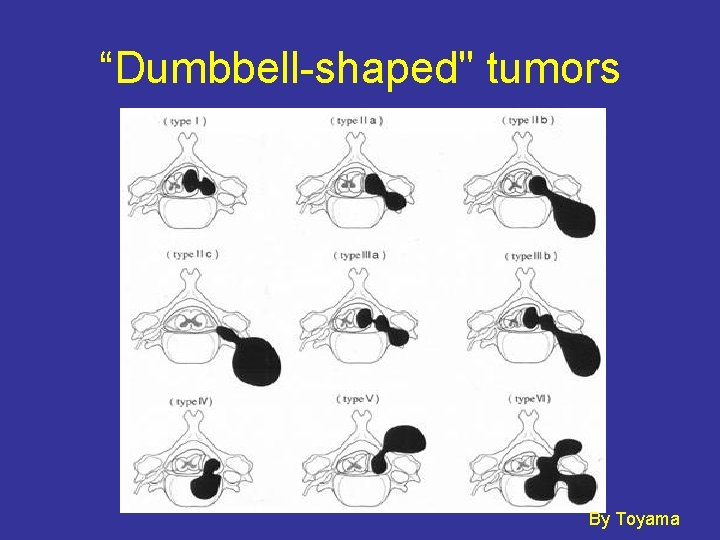“Dumbbell-shaped" tumors By Toyama 