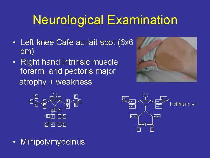 Neurological Examination • Left knee Cafe au lait spot (6 x 6 cm) •