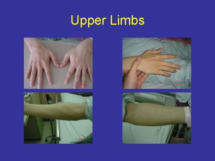 Upper Limbs 