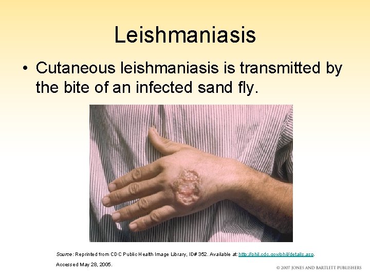 Leishmaniasis • Cutaneous leishmaniasis is transmitted by the bite of an infected sand fly.