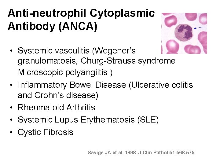 Anti-neutrophil Cytoplasmic Antibody (ANCA) • Systemic vasculitis (Wegener’s granulomatosis, Churg-Strauss syndrome Microscopic polyangiitis )