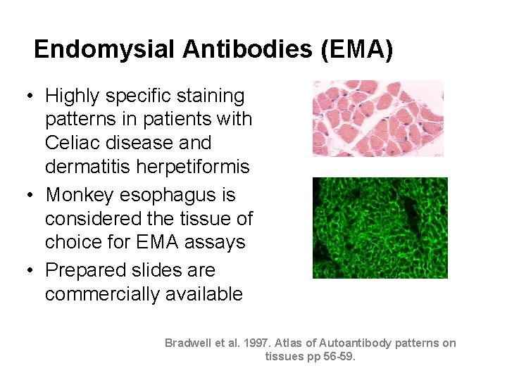 Endomysial Antibodies (EMA) • Highly specific staining patterns in patients with Celiac disease and