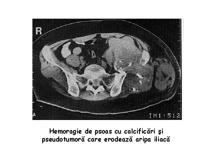 Hemoragie de psoas cu calcificări şi pseudotumoră care erodează aripa iliacă 