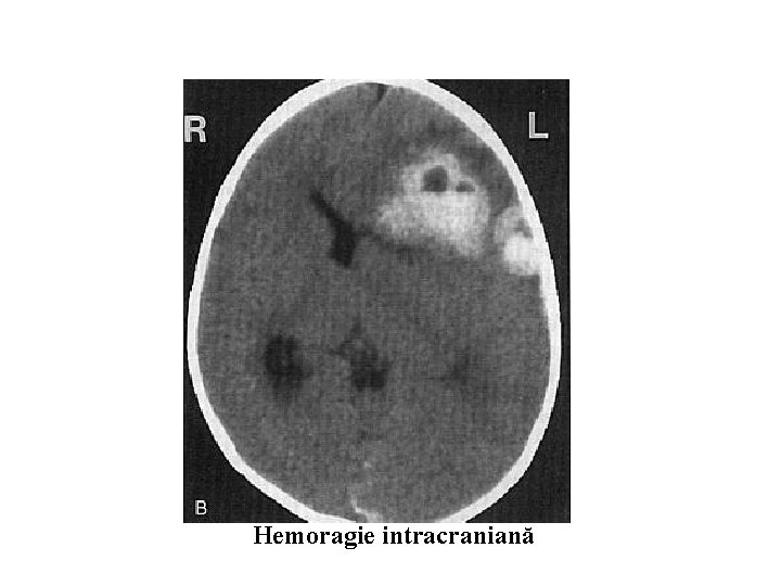 Hemoragie intracraniană 