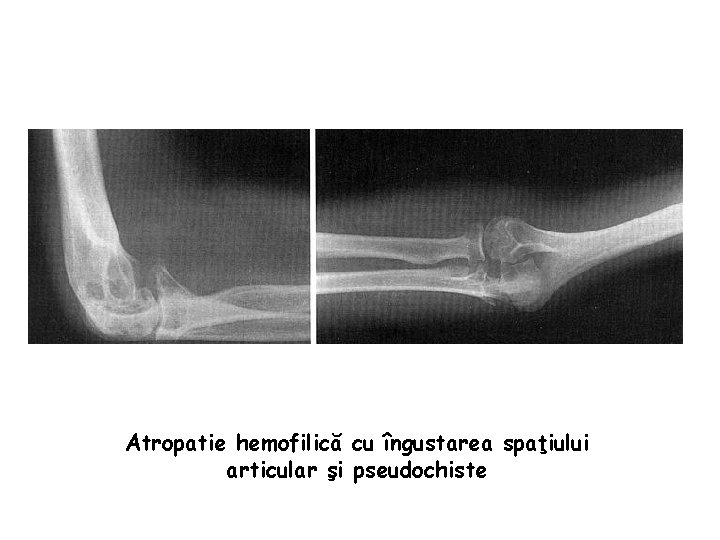Atropatie hemofilică cu îngustarea spaţiului articular şi pseudochiste 