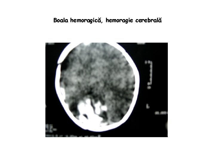 Boala hemoragică, hemoragie cerebrală 