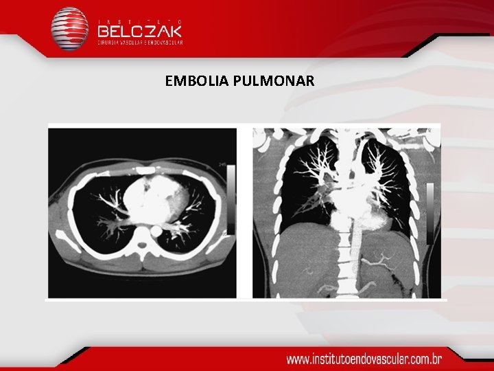 EMBOLIA PULMONAR 
