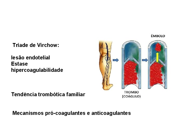 Tríade de Virchow: lesão endotelial Estase hipercoagulabilidade Tendência trombótica familiar Mecanismos pró-coagulantes e anticoagulantes