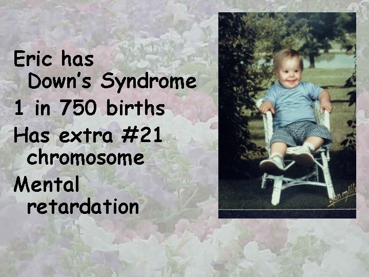 Eric has Down’s Syndrome 1 in 750 births Has extra #21 chromosome Mental retardation