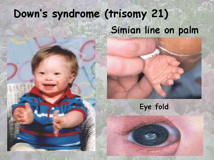 Down’s syndrome (trisomy 21) Simian line on palm Eye fold 