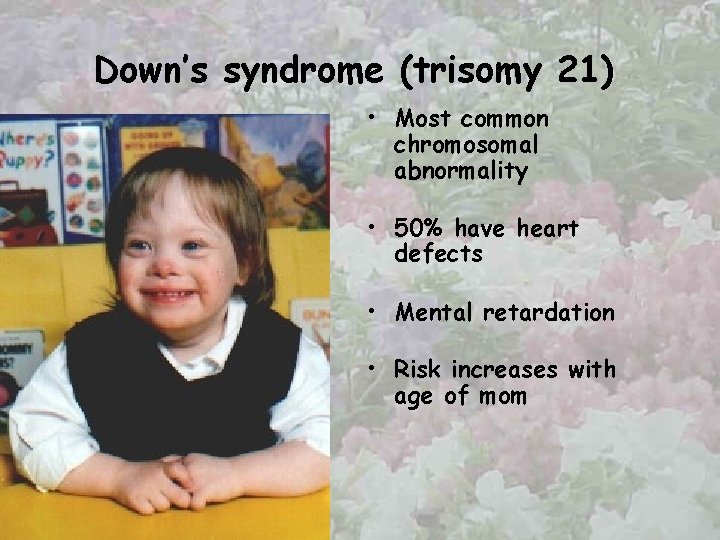 Down’s syndrome (trisomy 21) • Most common chromosomal abnormality • 50% have heart defects
