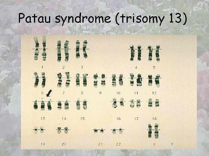 Patau syndrome (trisomy 13) 