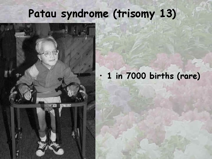 Patau syndrome (trisomy 13) • 1 in 7000 births (rare) 