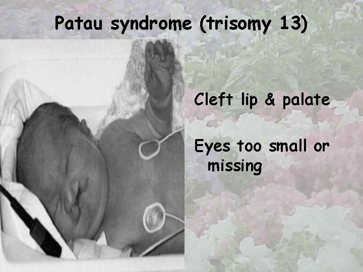 Patau syndrome (trisomy 13) Cleft lip & palate Eyes too small or missing 