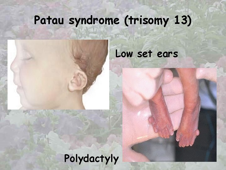 Patau syndrome (trisomy 13) Low set ears Polydactyly 