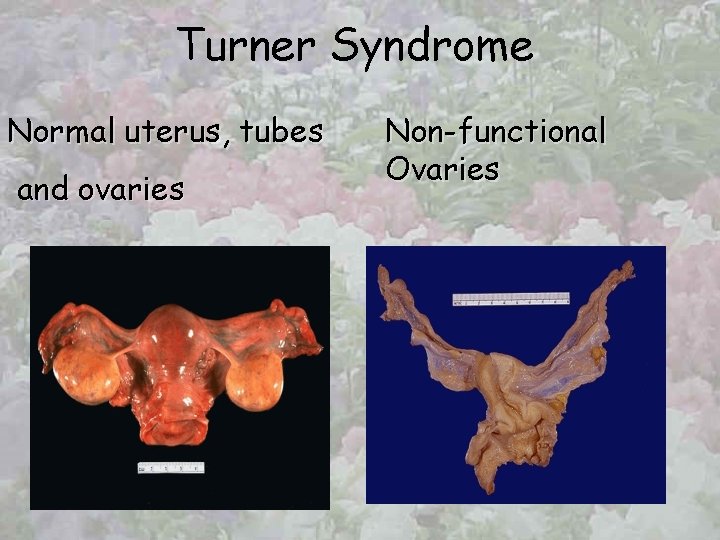 Turner Syndrome Normal uterus, tubes and ovaries Non-functional Ovaries 