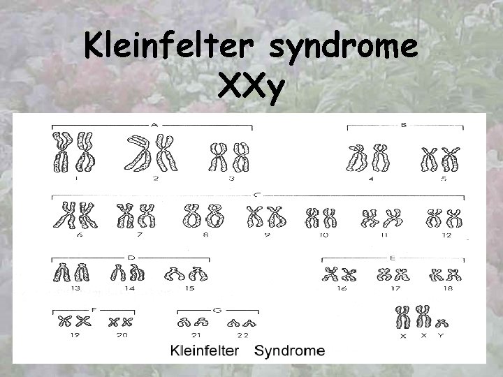 Kleinfelter syndrome XXy 