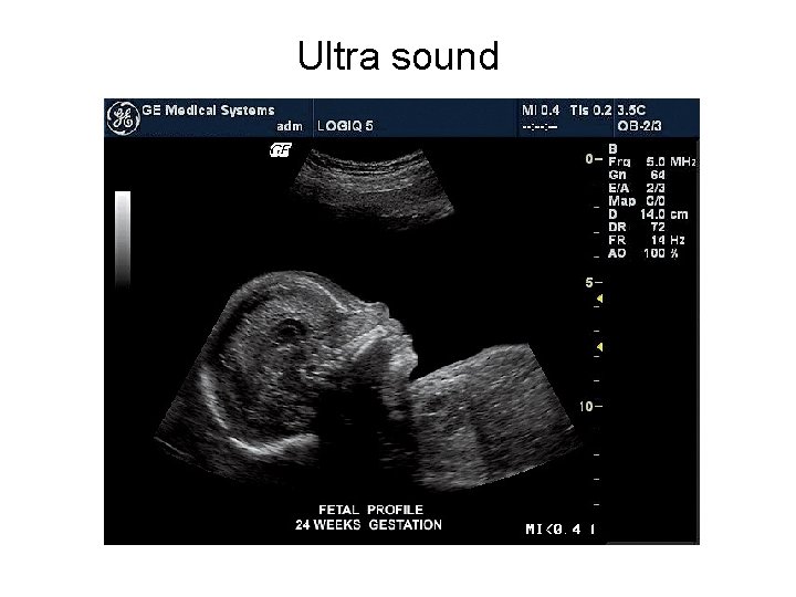 Ultra sound 