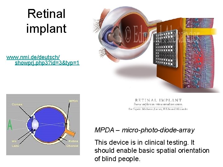 Retinal implant www. nmi. de/deutsch/ showprj. php 3? id=3&typ=1 MPDA – micro-photo-diode-array This device