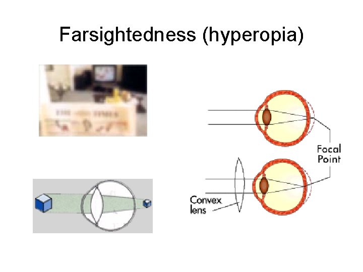 Farsightedness (hyperopia) 